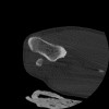SPORK, NICO - 22.03.1976 - 02.08.2022 - CT obere Extremität - 17:51:17